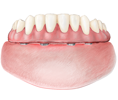 Prothèse dentaire fixe - Dentier, Bridge, Implant, Couronne - Prix et Usage