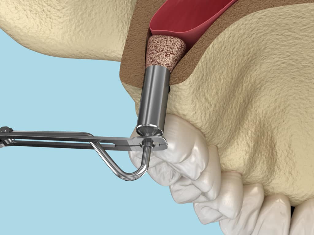 sinus lift implant dentaire clinique implantologie et chirurgie orale A&M Groupe