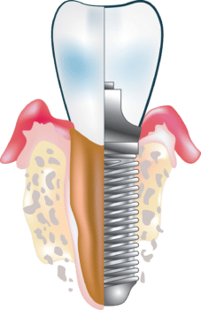 Tarifs implant dentaire – dentier