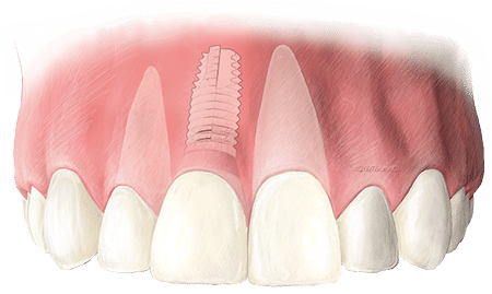 Tarifs implant dentaire – dentier