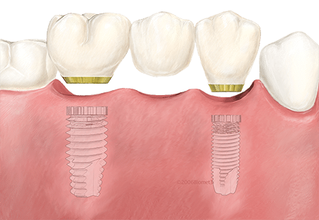 Prothèse dentaire fixe - Dentier, Bridge, Implant, Couronne - Prix et Usage