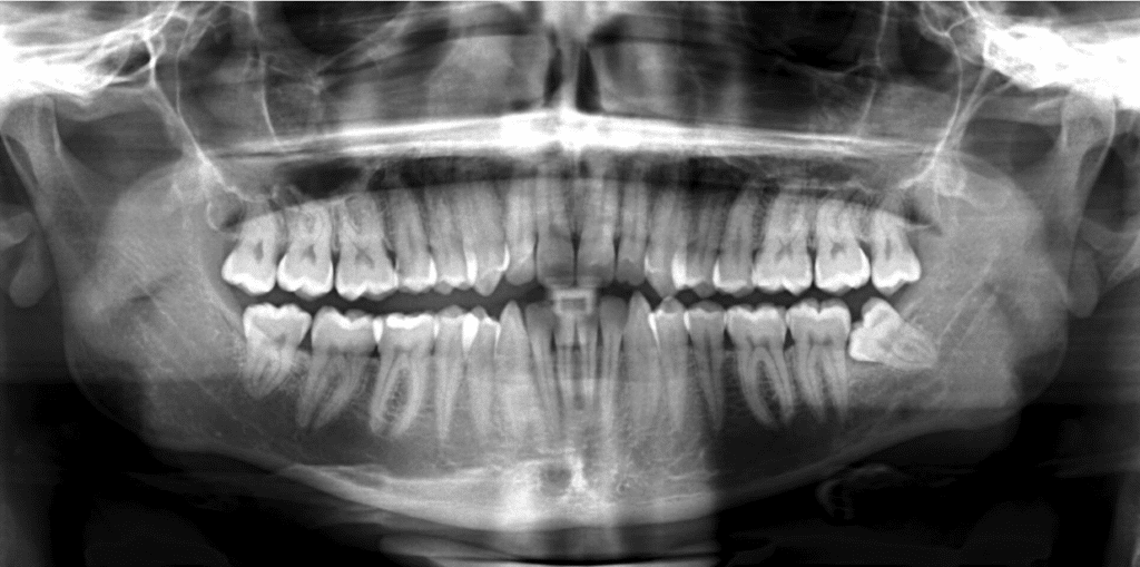 Extraction dents de sagesse
